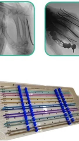 HASTES INTRAMEDULAR FLEXÍVEL TEEM webp